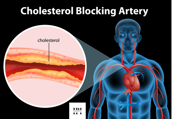 cholesterol blocking artery
